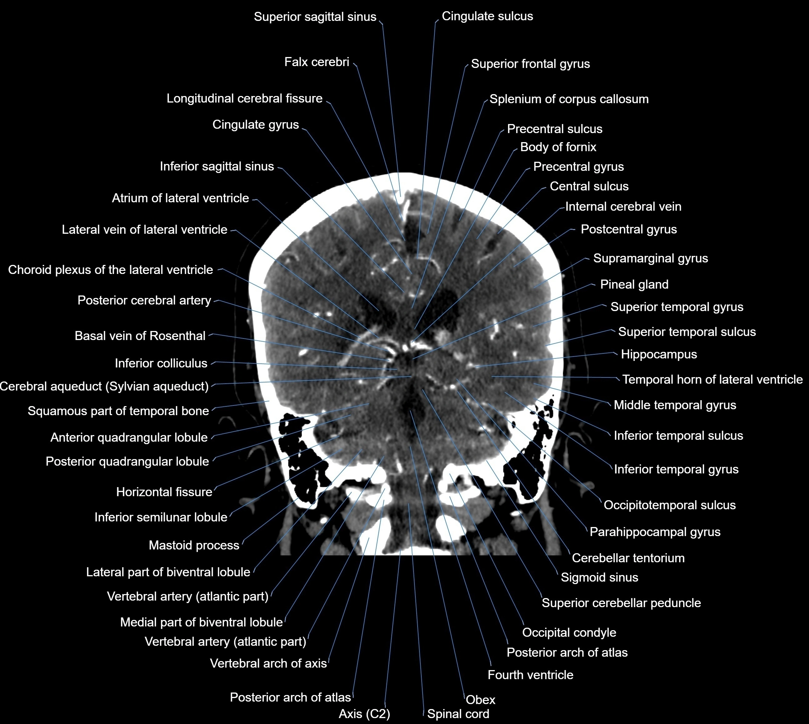 CT Brain coronal cross sectional radiology anatomy image  -img-00001-030.webp